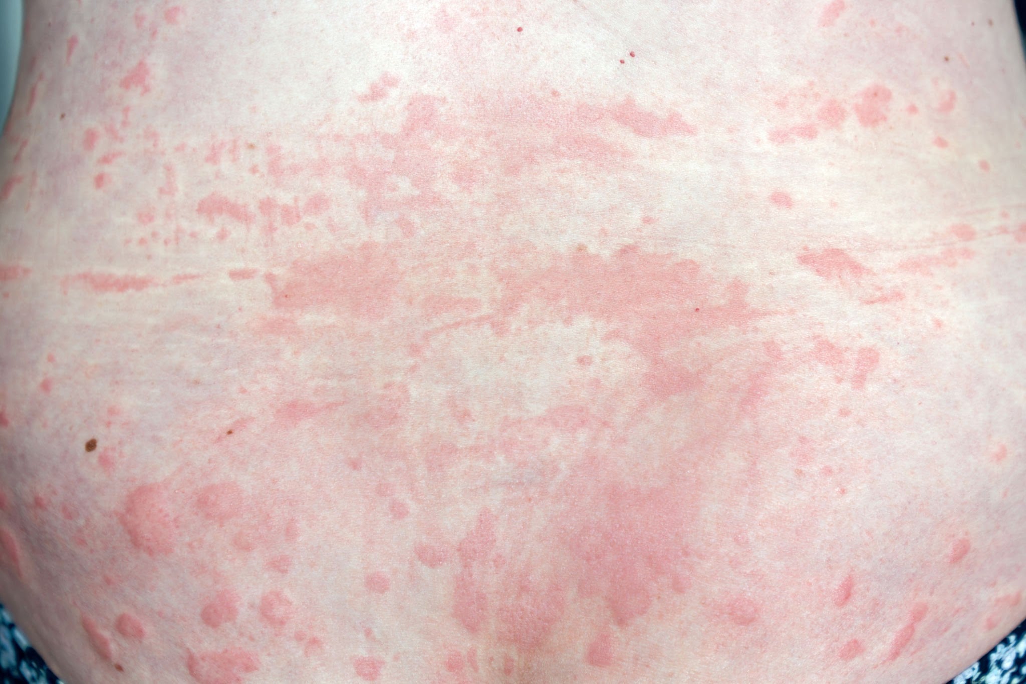 PUPPP Rash Image