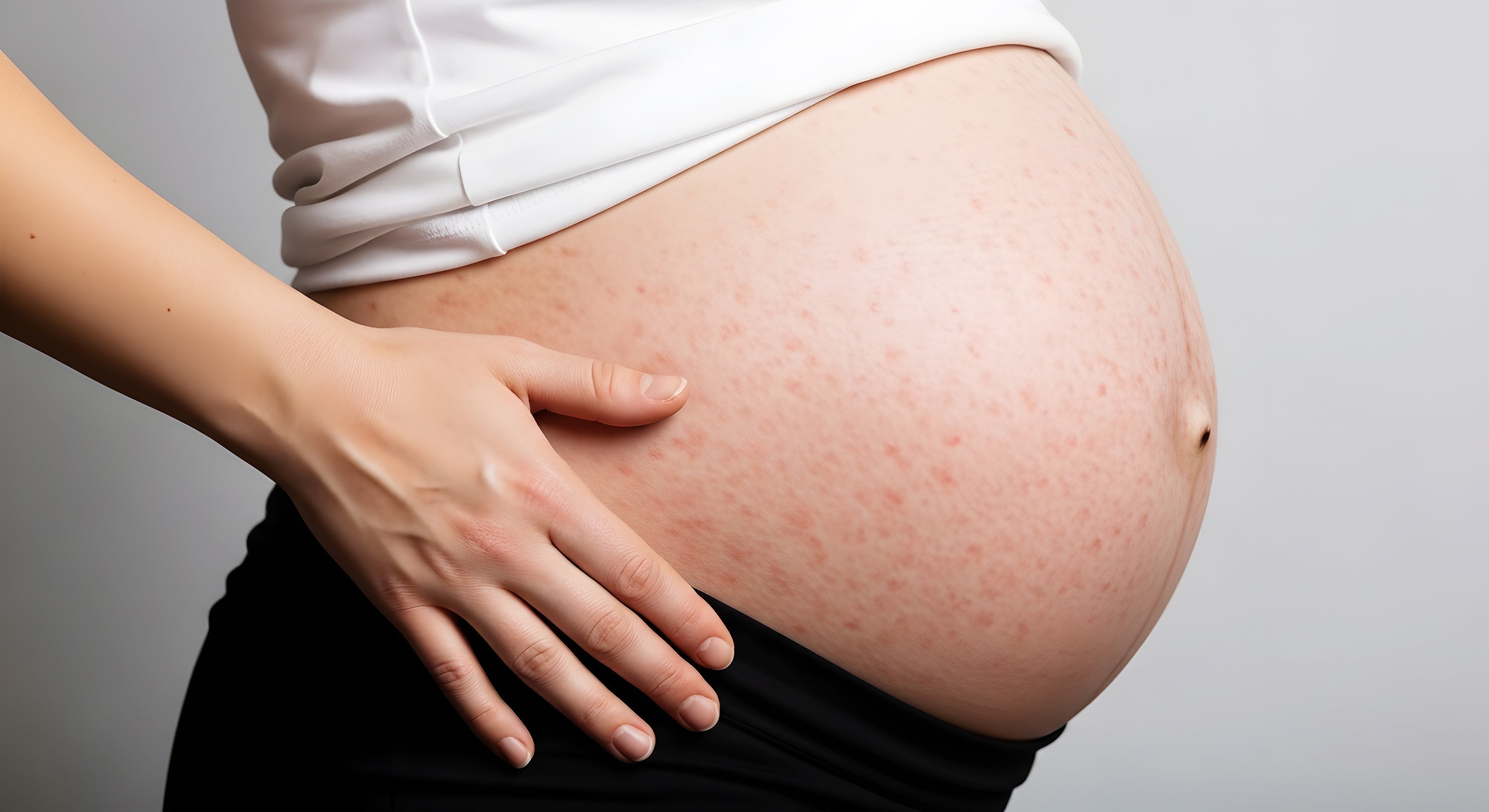 Puppp rash during pregnancy 