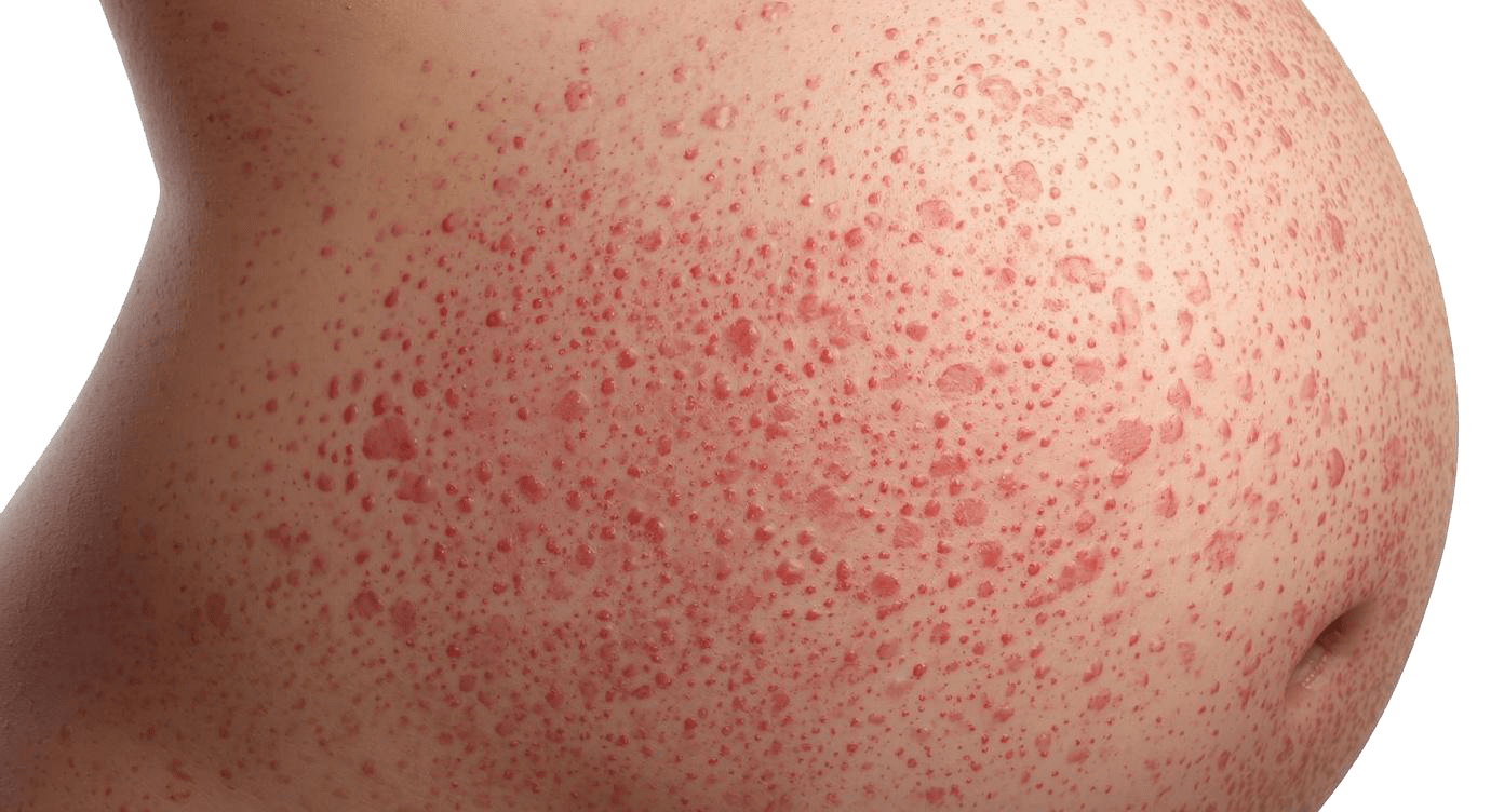 PUPPP Rash - Image of pregnant woman with puppp rash on belly.